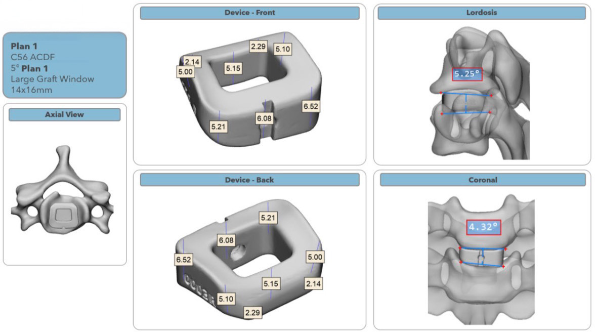 USA Health performs first surgery using 3D-printed cervical spine implant spanning six-state area