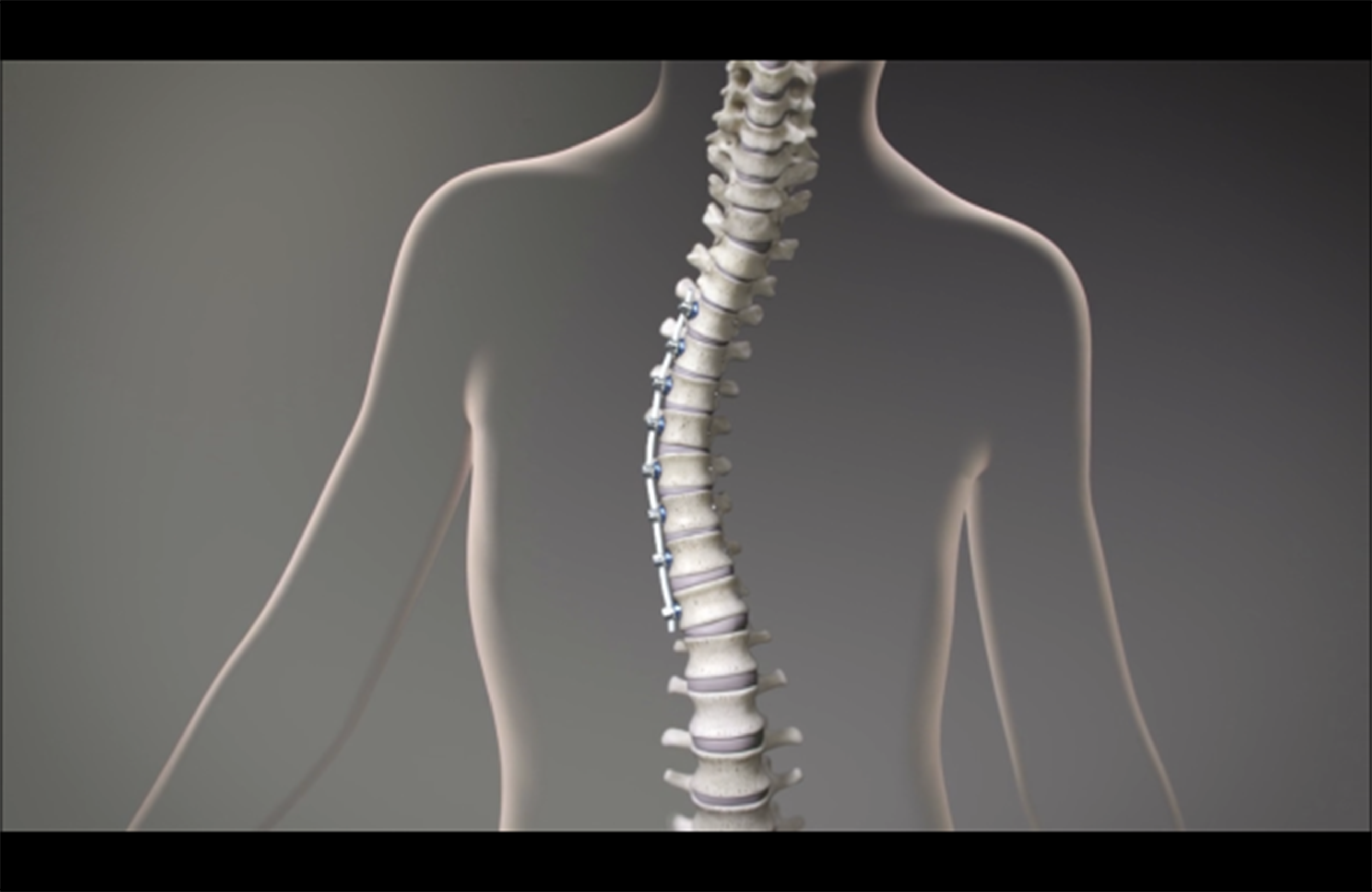 USA Health first in state to offer vertebral body tethering for scoliosis