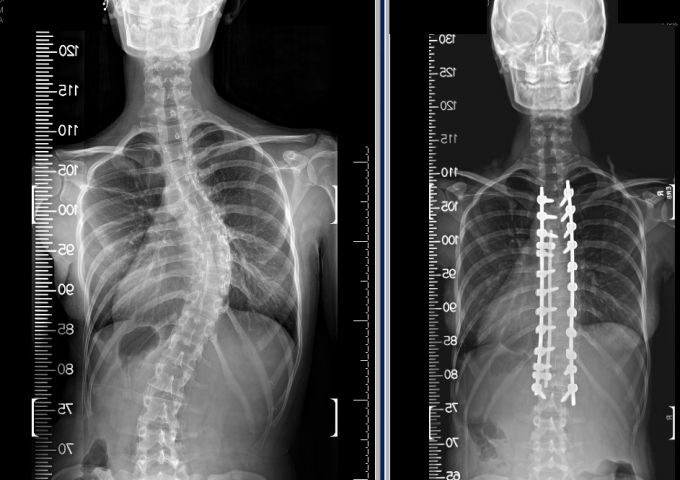 USA Health neurosurgeon accepted into premier scoliosis society