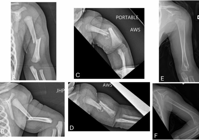 USA Health article on neonatal birth fractures published in academic journal