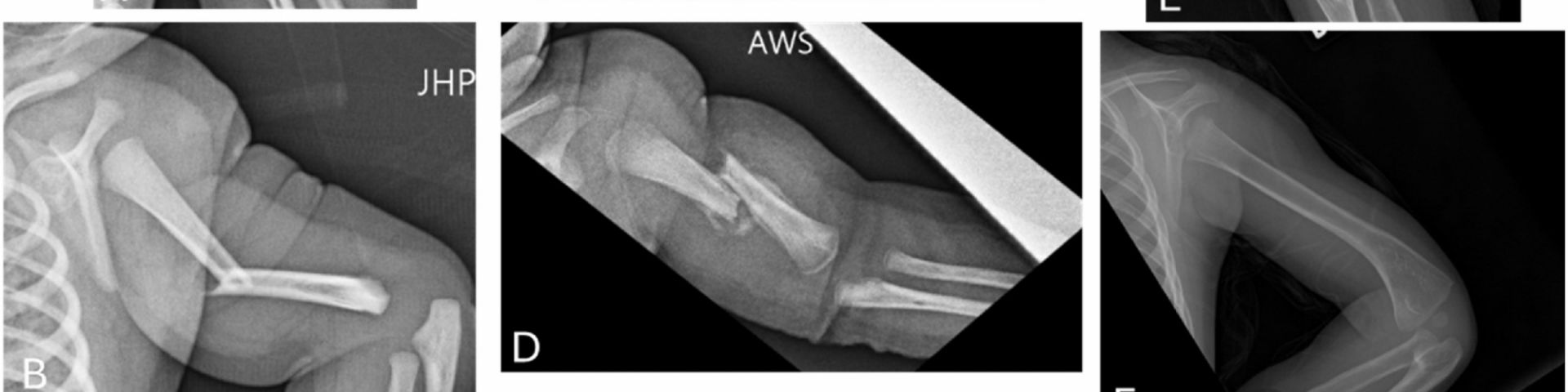 USA Health article on neonatal birth fractures published in academic journal